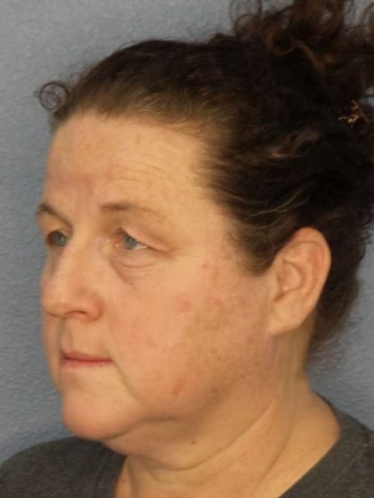 Periorbital Before & After Patient #8527