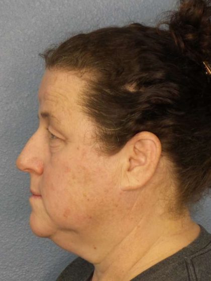 Periorbital Before & After Patient #8527