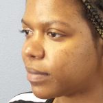 Rhinoplasty Before & After Patient #10038