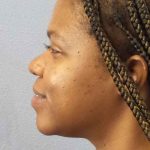 Rhinoplasty Before & After Patient #10038