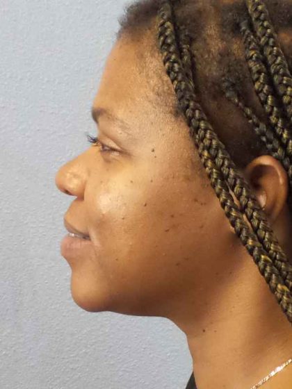 Rhinoplasty Before & After Patient #10038