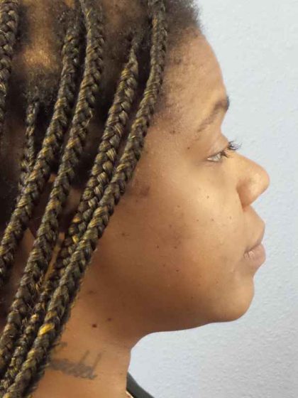 Rhinoplasty Before & After Patient #10038