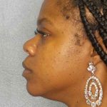 Rhinoplasty Before & After Patient #10038