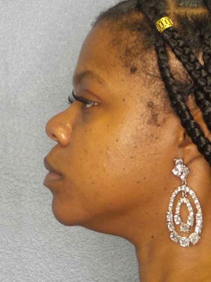 Rhinoplasty Before & After Patient #10038