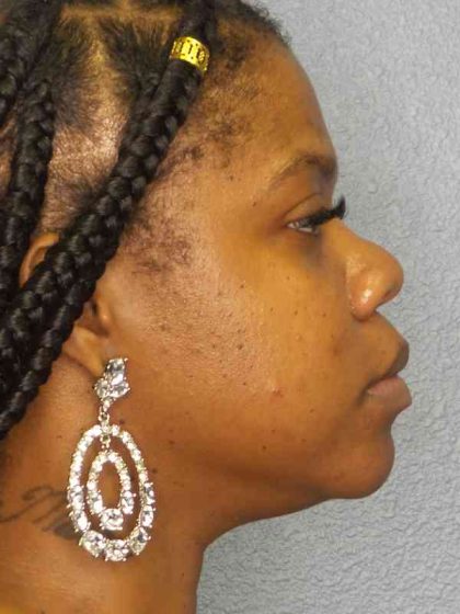 Rhinoplasty Before & After Patient #10038