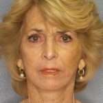 Facelift Before & After Patient #7554
