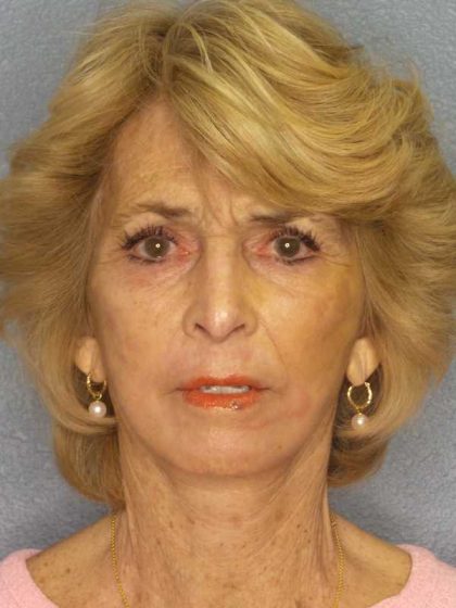 Facelift Before & After Patient #7554
