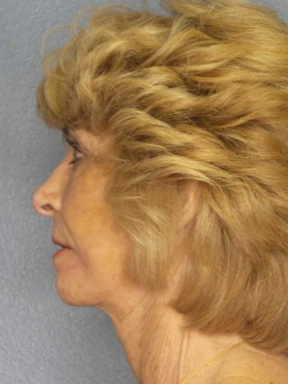 Facelift Before & After Patient #7554
