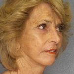 Facelift Before & After Patient #7554