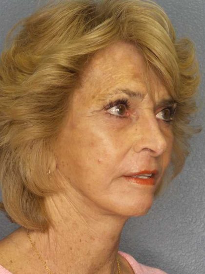 Facelift Before & After Patient #7554