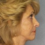 Facelift Before & After Patient #7554