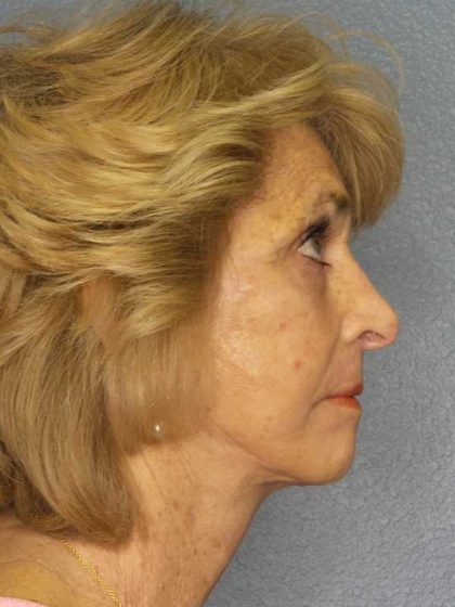 Facelift Before & After Patient #7554