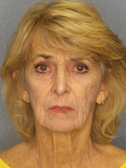 Facelift Before & After Patient #7554
