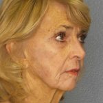Facelift Before & After Patient #7554