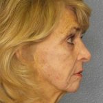 Facelift Before & After Patient #7554