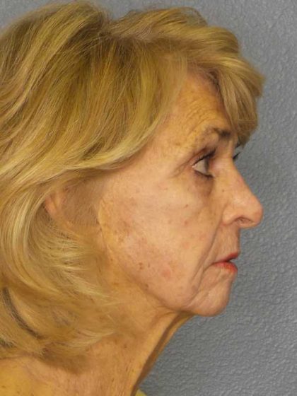 Facelift Before & After Patient #7554