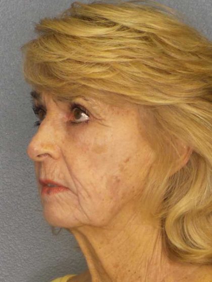 Facelift Before & After Patient #7554