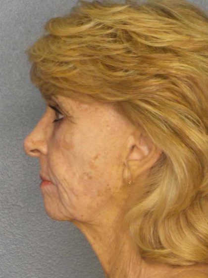 Facelift Before & After Patient #7554