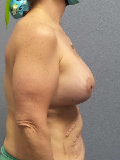 Breast Lift with Implant (Augmentation Mastopexy) Before & After Patient #4601