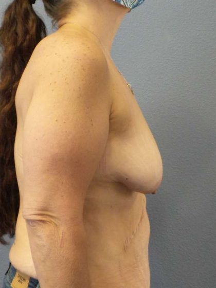 Breast Lift with Implant (Augmentation Mastopexy) Before & After Patient #4601