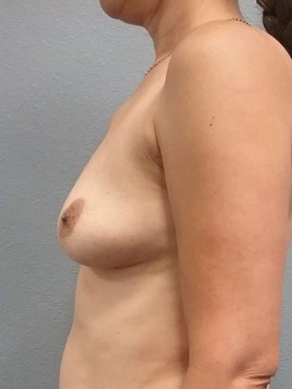 Breast Augmentation Revision (Breast Enlargement Repair) Before & After Patient #7421