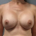 Breast Augmentation Revision (Breast Enlargement Repair) Before & After Patient #7421