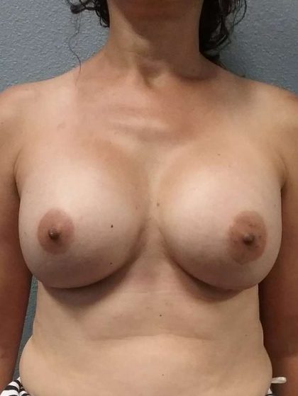 Breast Augmentation Revision (Breast Enlargement Repair) Before & After Patient #7421