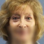 Periorbital Before & After Patient #8699
