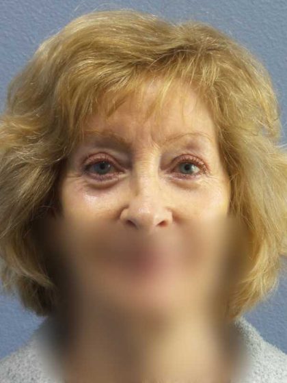Periorbital Before & After Patient #8699