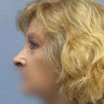 Periorbital Before & After Patient #8699