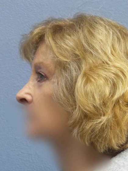 Periorbital Before & After Patient #8699