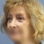 Periorbital Before & After Patient #8699
