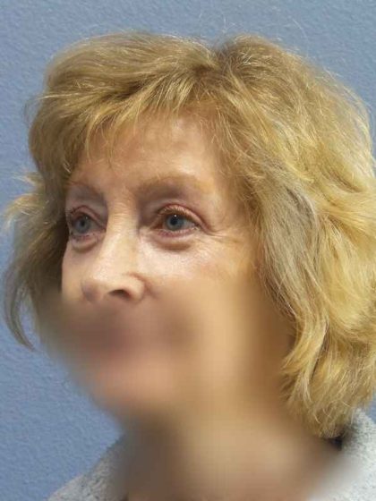 Periorbital Before & After Patient #8699