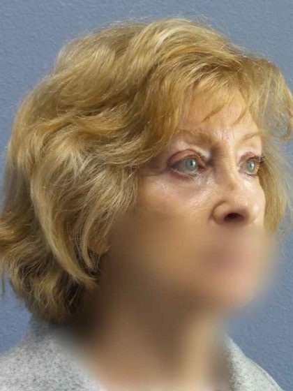 Periorbital Before & After Patient #8699