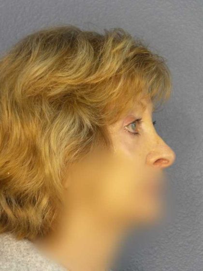 Periorbital Before & After Patient #8699
