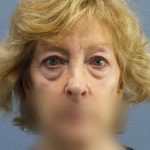 Periorbital Before & After Patient #8699