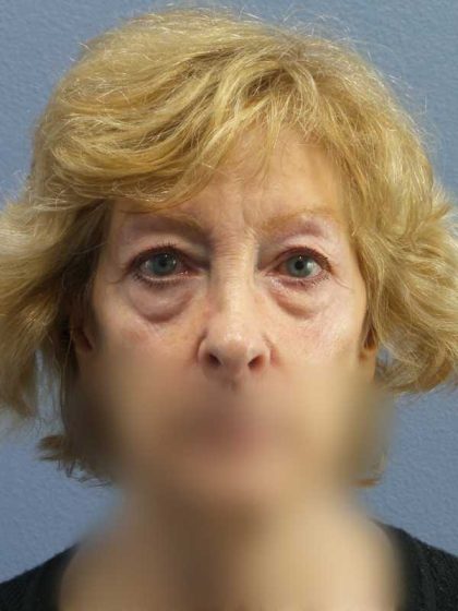 Periorbital Before & After Patient #8699