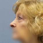 Periorbital Before & After Patient #8699