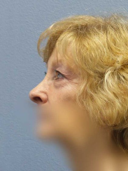 Periorbital Before & After Patient #8699