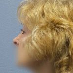 Periorbital Before & After Patient #8699