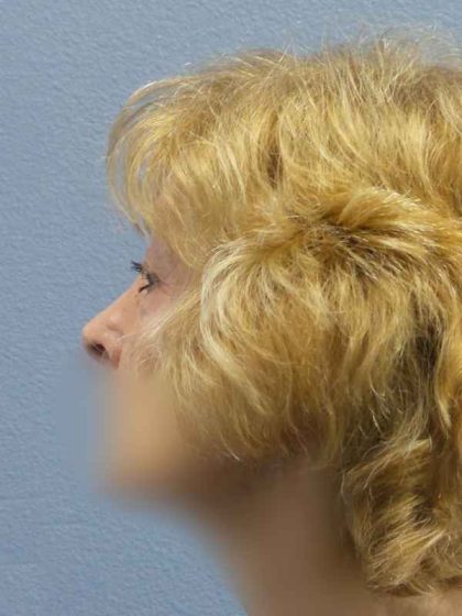 Periorbital Before & After Patient #8699