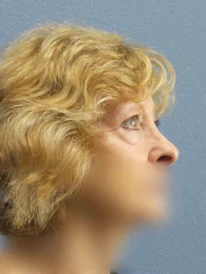 Periorbital Before & After Patient #8699