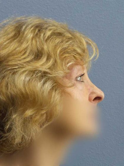 Periorbital Before & After Patient #8699