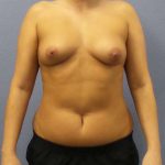 Breast Augmentation Before & After Patient #5576