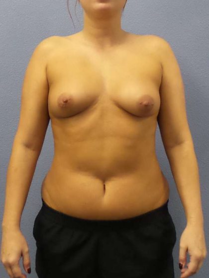 Breast Augmentation Before & After Patient #5576