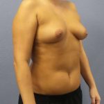 Breast Augmentation Before & After Patient #5576