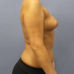 Breast Augmentation Before & After Patient #5576