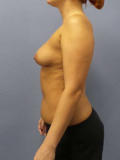 Breast Augmentation Before & After Patient #5576
