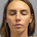 Rhinoplasty Before & After Patient #9746