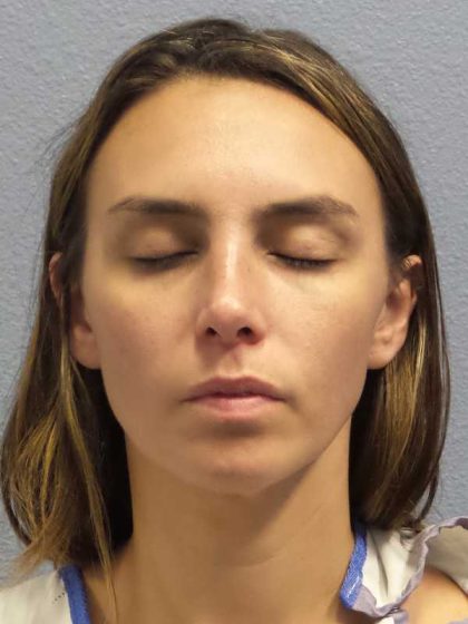 Rhinoplasty Before & After Patient #9746